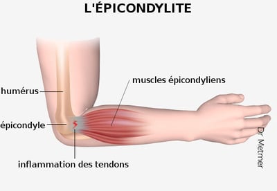 epicondylite explication